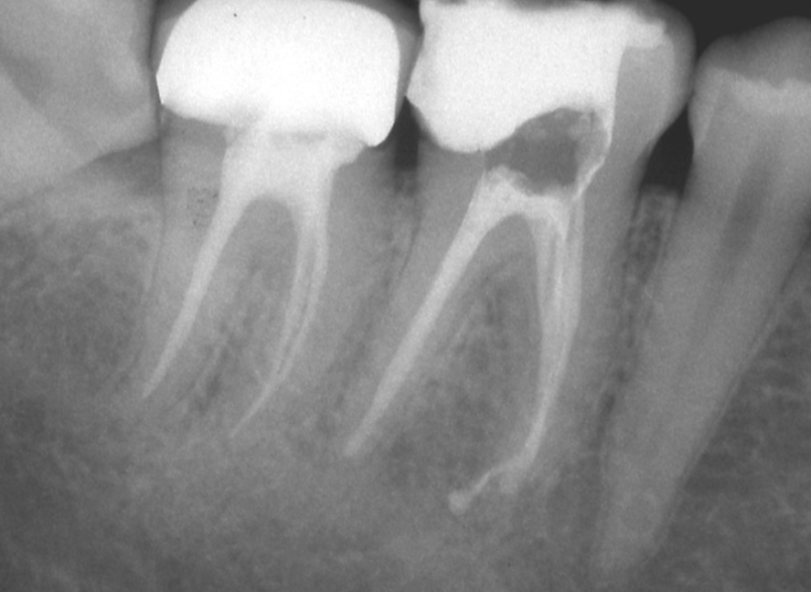 endografia endorale denti molari studio dentistico cremona